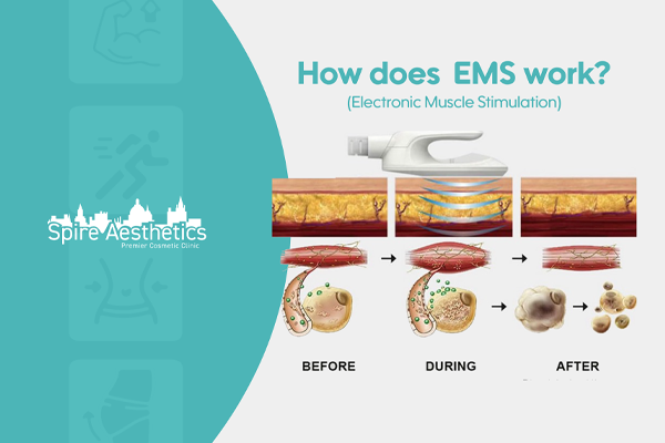 EMS treatment for post pregnancy weight loss treatment Paisley