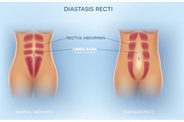 What Non-Surgical Options Are Available for Diastasis Recti Paisley?