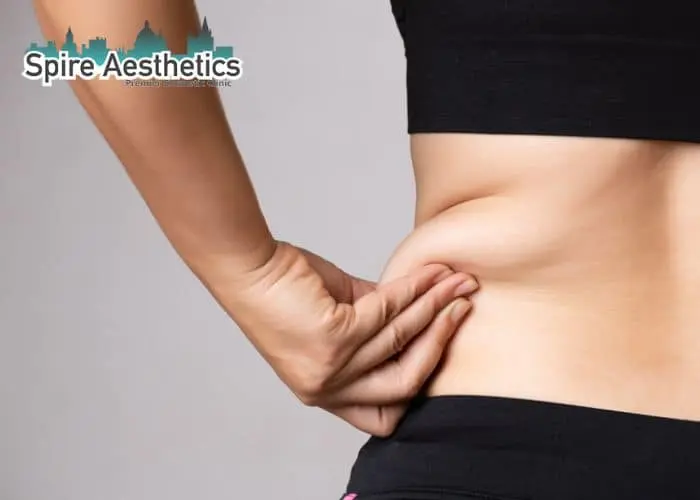 Image of woman pinching fat on their hips Paisley. Fat Freezing treatment