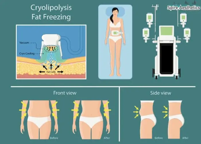 Fat freezing treatment Paisley benefits for competitions to remove stubborn fat deposits.