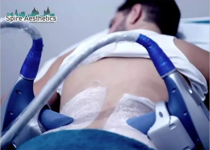 Man having fat freezing treatment done on love handles before a competitions Paisley to create a sculpted look.