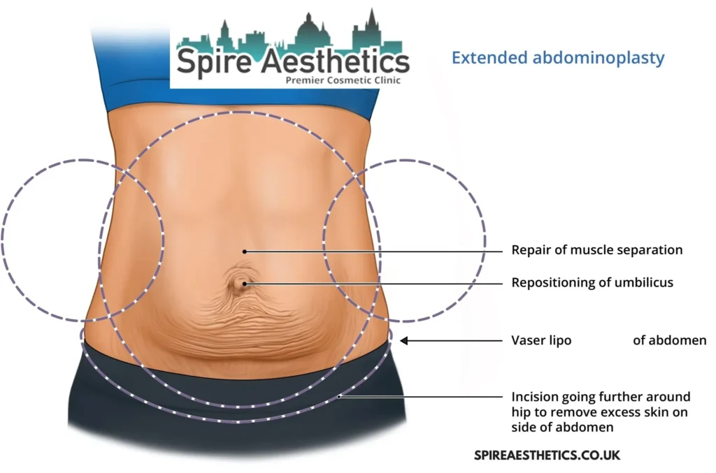 Understanding Loose Skin After Gastric Band Paisley Surgery and HIFU Treatment