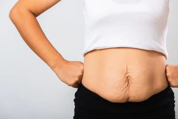 Image of a woman's stomach after weight loss with sagging skin following a gastric band Paisley