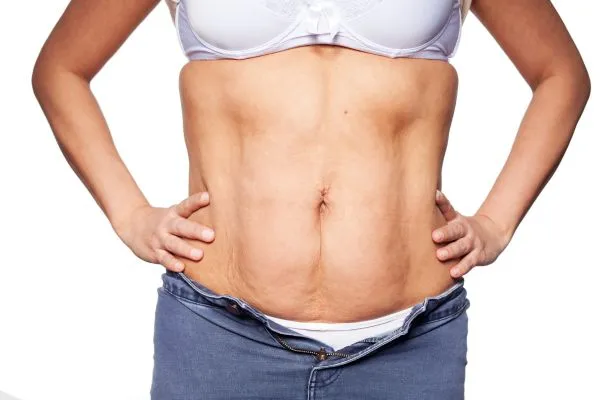 sagging skin on woman's stomach after weight loss injections Paisley