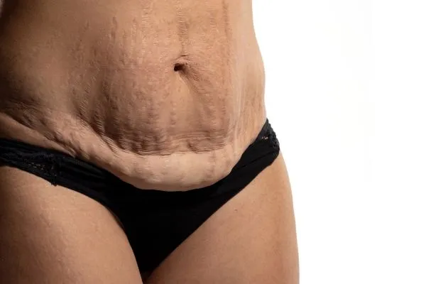 Image of womans stomach after weight loss injections Paisley showing saggy skin