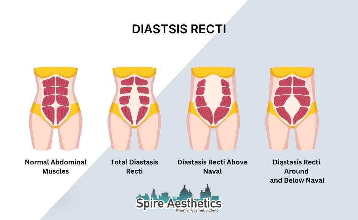 Is Non-Surgical Diastasis Recti Treatment Right for You? Common Concerns Answered Paisley
